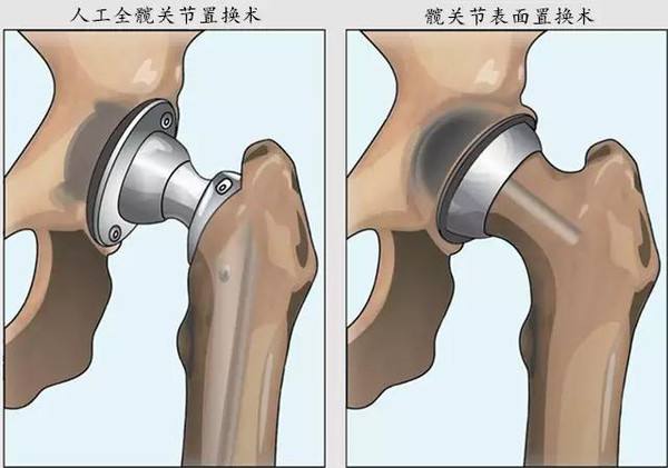 髋关节手术3.jpg